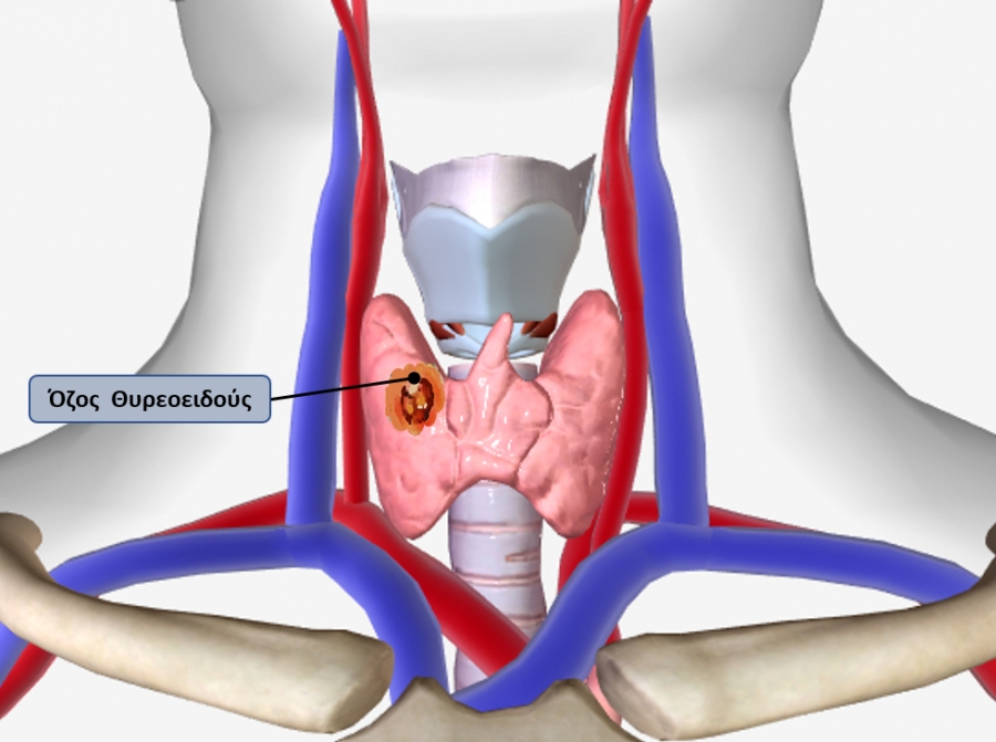 Οζος Θυρεοειδούς