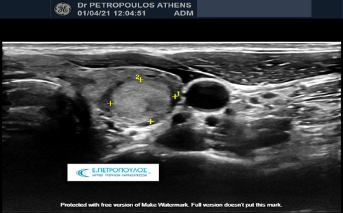 Παρακέντηση - Βιοψία με λεπτή βελόνα (FNA) Θυρεοειδούς - Τραχήλου
